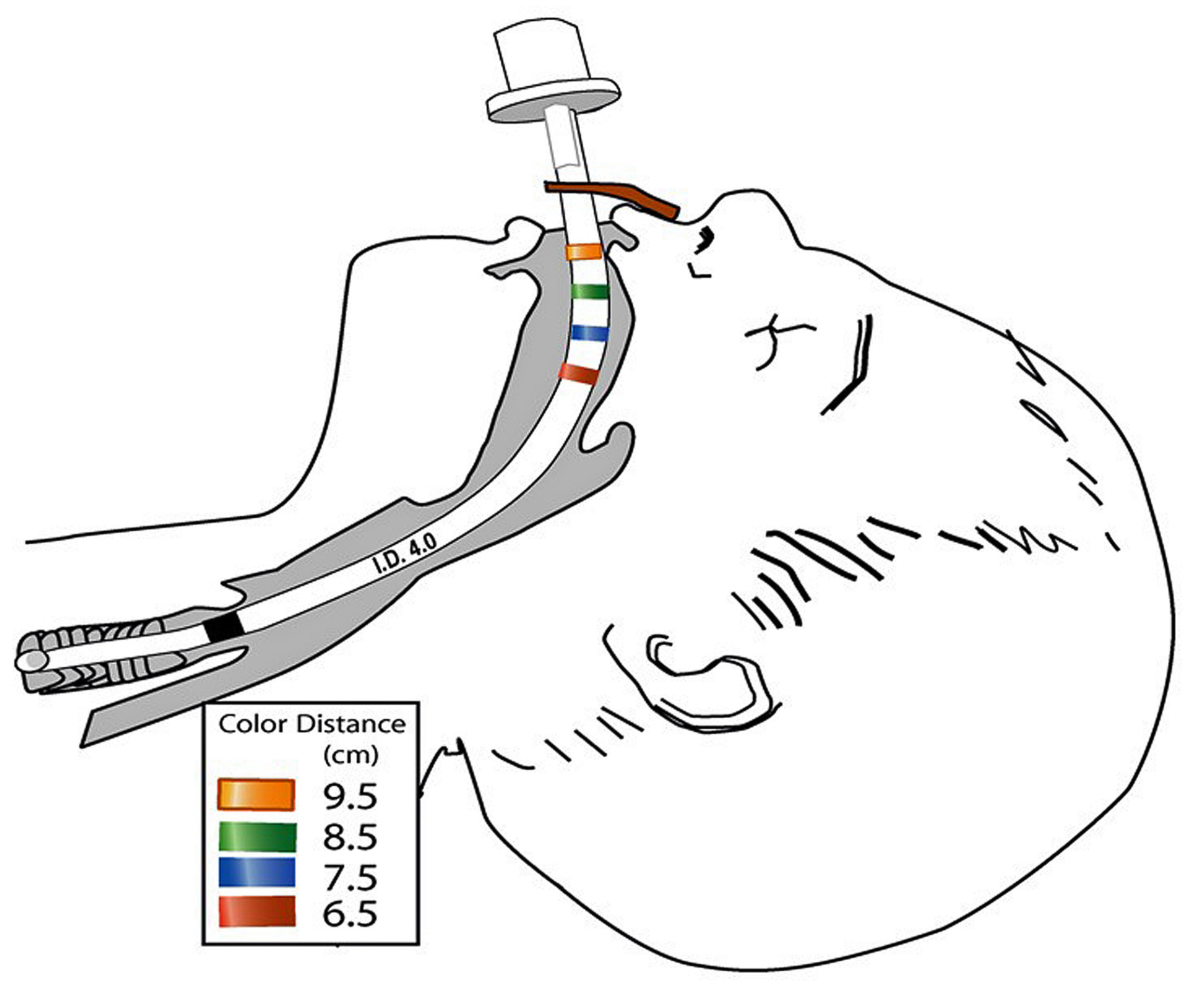 Neonatal Endotracheal Tubes And Prevention Of Bronchial Intubation 