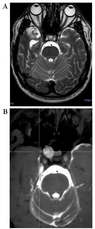 Spontaneous CSF Rhinorrhea as Clinical Symptom of an Idiopathic ...